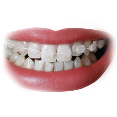 Keramikbrackets